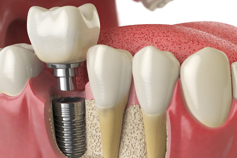 Tooth Implant